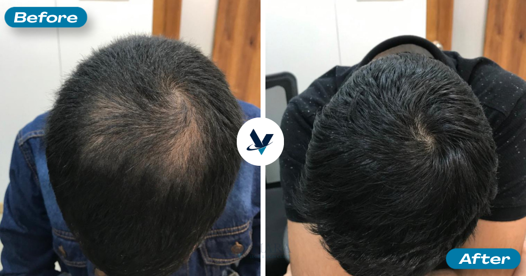Crown whorl density visibly improved - Hair Loss Treatment Bangalore, VTIARA Clinic