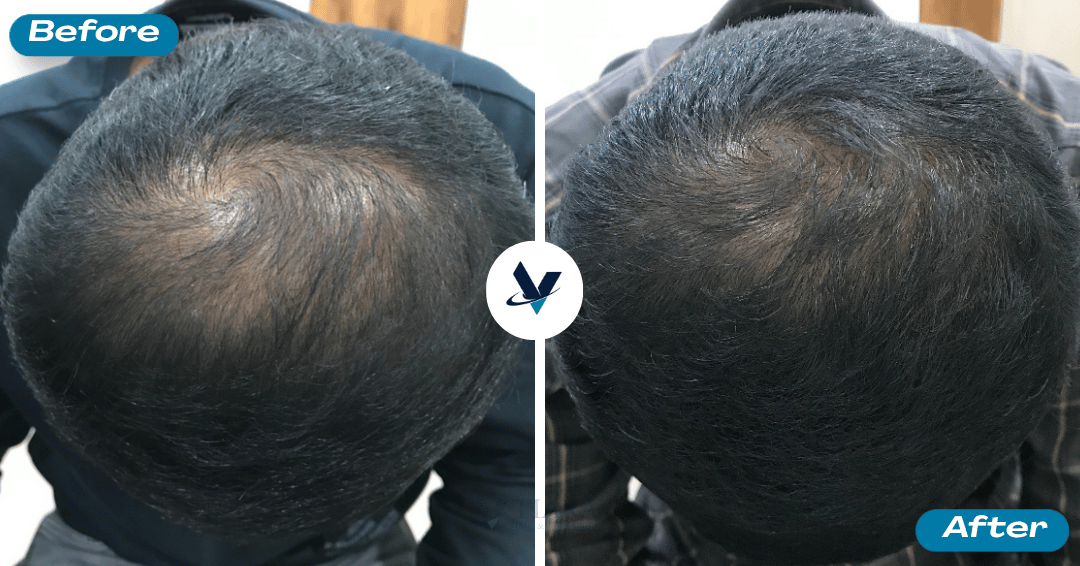 Crown whorl thinning visibly filled in - Hair Loss Treatment Bangalore, VTIARA Clinic