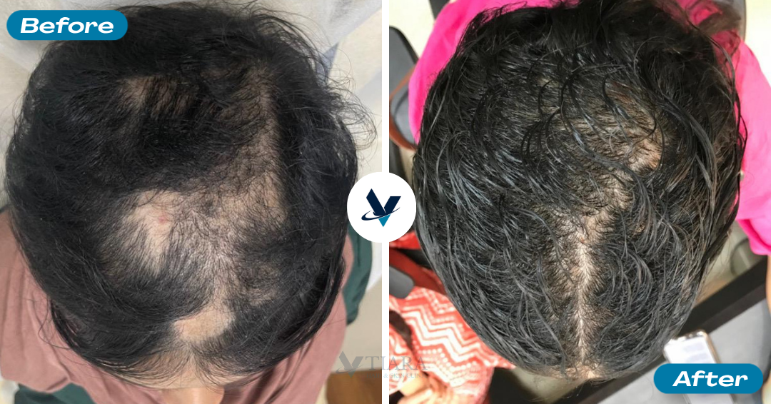 Bald patch at crown filled in - Hair Loss Treatment Bangalore, VTIARA Clinic