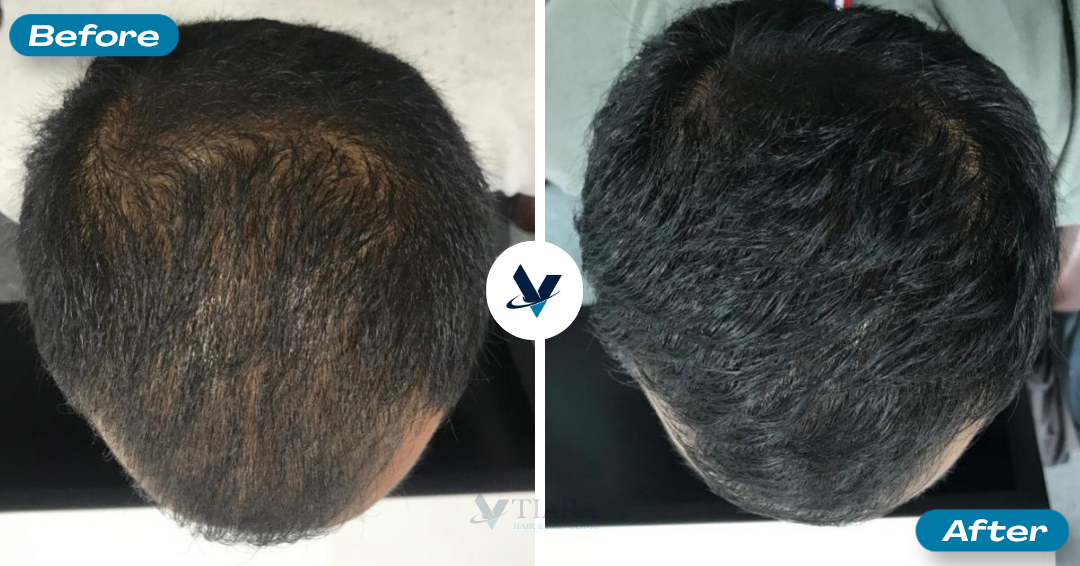 Diffuse thinning reduced, fuller coverage - Hair Loss Treatment Bangalore, VTIARA Clinic