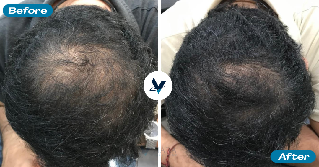 Crown hair density visibly thickened - Hair Loss Treatment Bangalore, VTIARA Clinic