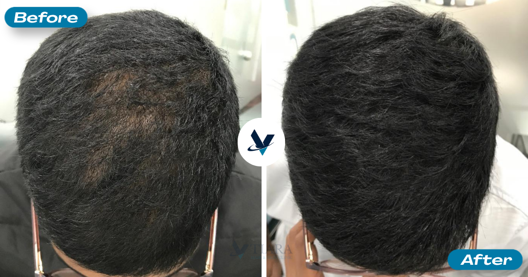 Frontal hairline parting filled in, fuller coverage - Hair Loss Treatment Bangalore, VTIARA Clinic