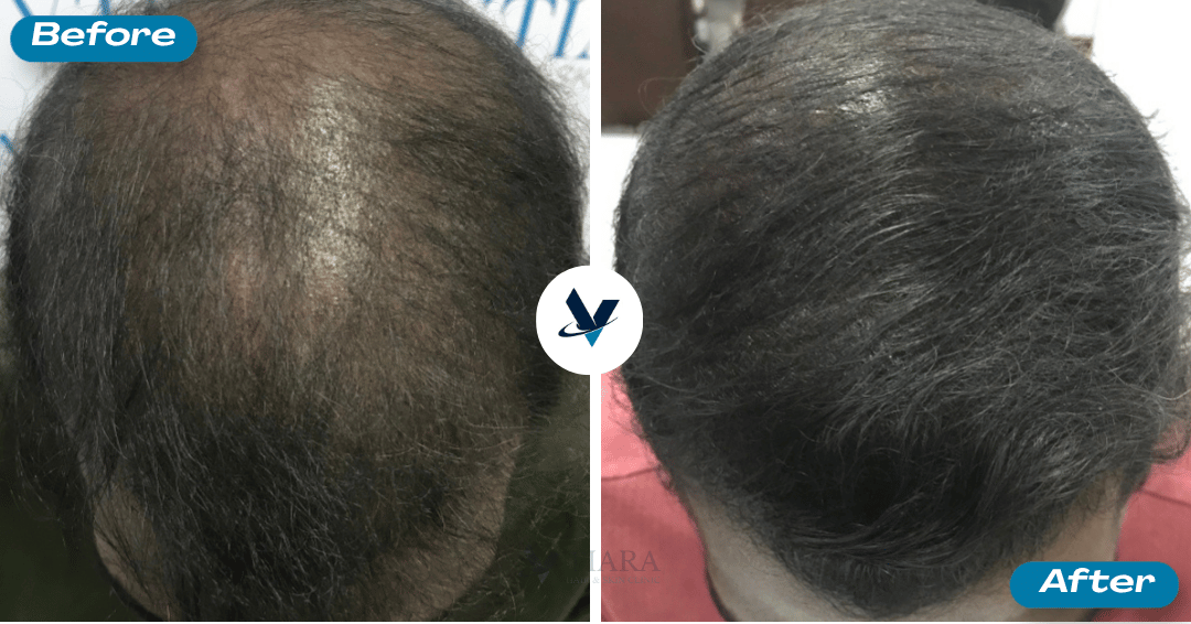 Extensive scalp thinning visibly reversed - Hair Loss Treatment Bangalore, VTIARA Clinic
