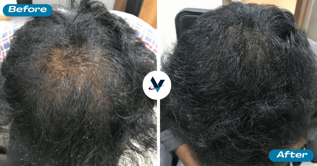 Patchy crown thinning filled in with denser regrowth - Hair Loss Treatment Bangalore, VTIARA Clinic